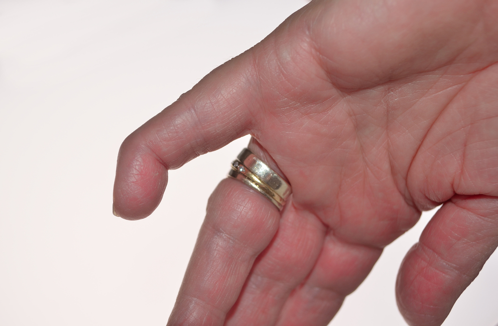 Mallet Finger condition Image