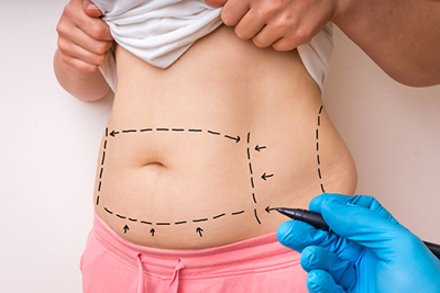 Tummy Tuck in Saginaw, MI