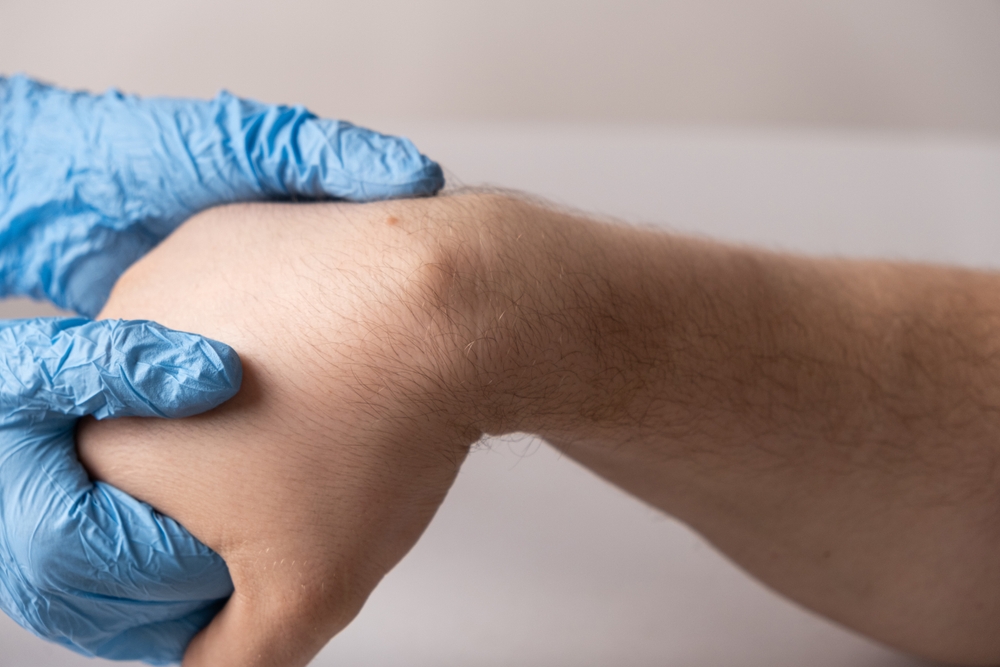 Ganglion Cyst condition Image